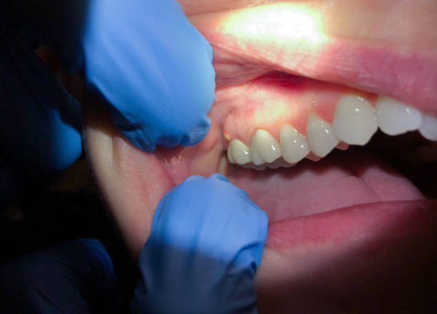 Best Broken Tooth Emergency  in Fredericktown, OH