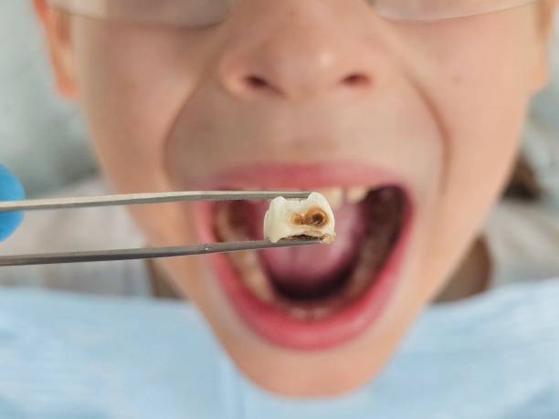 Best Dentist for Tooth Abscess  in Fredericktown, OH